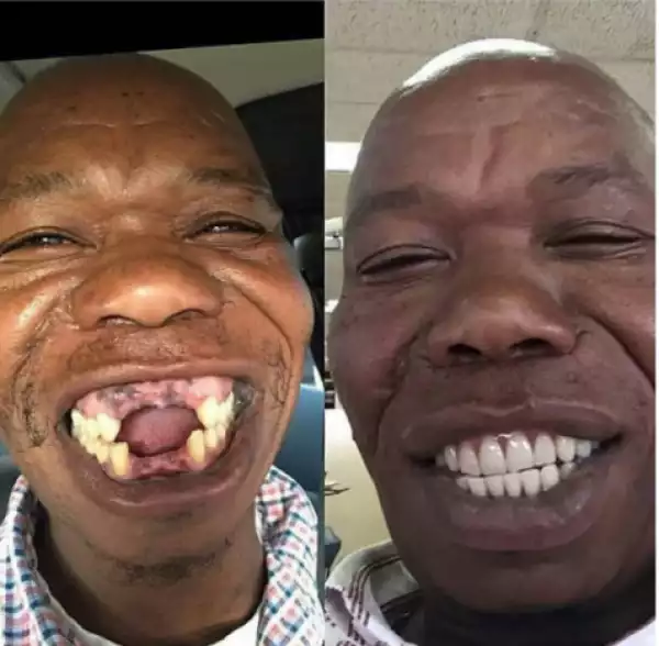 Toothless Man Gets Perfect Set Of Teeth. See Before & After Photos